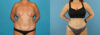Liposuction case #5964 slider thumbnail
