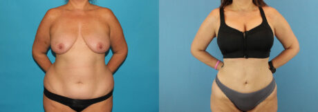 Liposuction case #5964