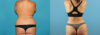 Liposuction case #5964 slider thumbnail