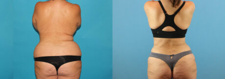 Liposuction case #5964