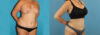 Liposuction case #5964 slider thumbnail