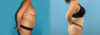 Liposuction case #5964 slider thumbnail