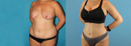 Liposuction case #5964