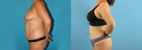Liposuction case #5964