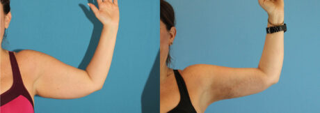 Liposuction case #5963