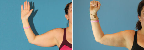 Liposuction case #5963