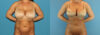 Liposuction case #5962 slider thumbnail