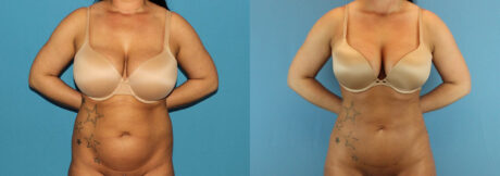 Liposuction case #5962