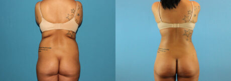 Liposuction case #5962