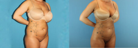 Liposuction case #5962