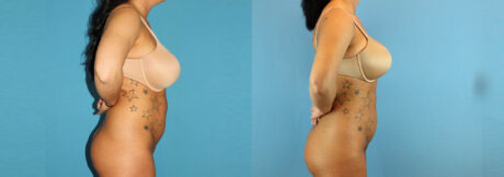 Liposuction case #5962