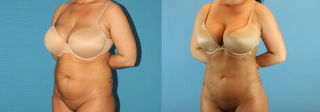 Liposuction case #5962