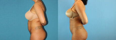 Liposuction case #5962