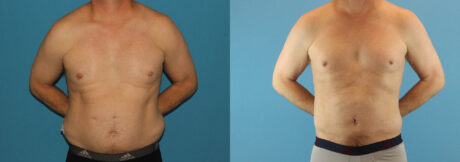 Liposuction case #5965