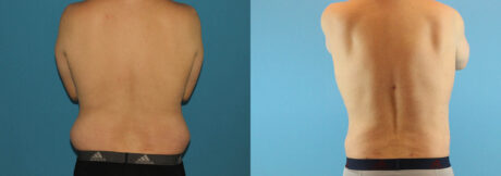 Liposuction case #5965