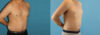 Liposuction case #5965 slider thumbnail