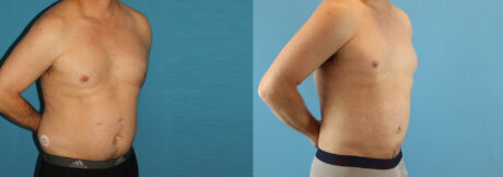 Liposuction case #5965