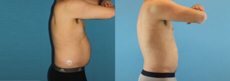 Liposuction case #5965