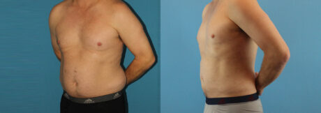 Liposuction case #5965