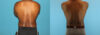 Liposuction case #5966 slider thumbnail