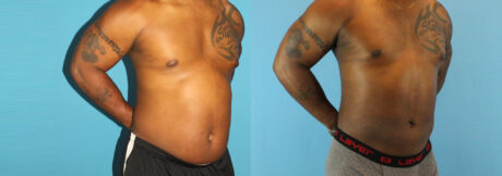 Liposuction case #5966