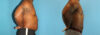 Liposuction case #5966 slider thumbnail