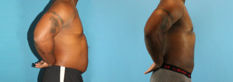 Liposuction case #5966