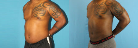 Liposuction case #5966