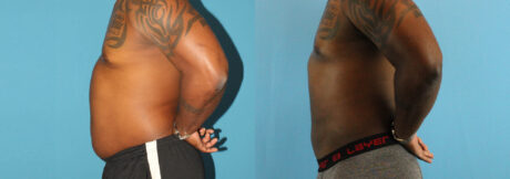 Liposuction case #5966