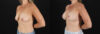 Breast Lift with Implants case #7903 slider thumbnail