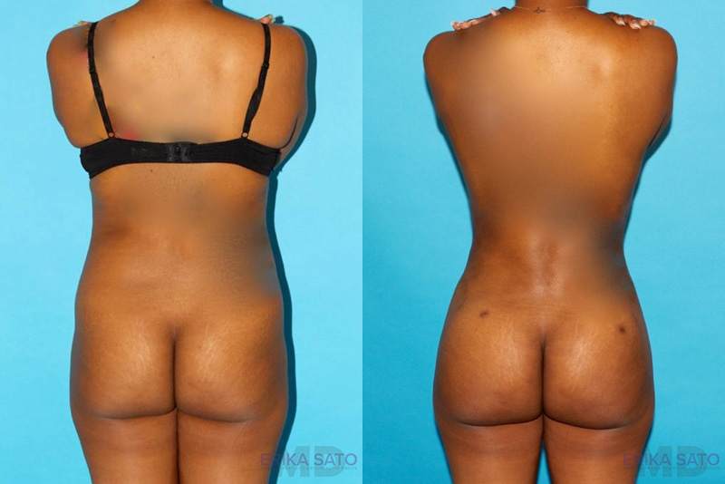 Brazilian Butt Lift case #4640