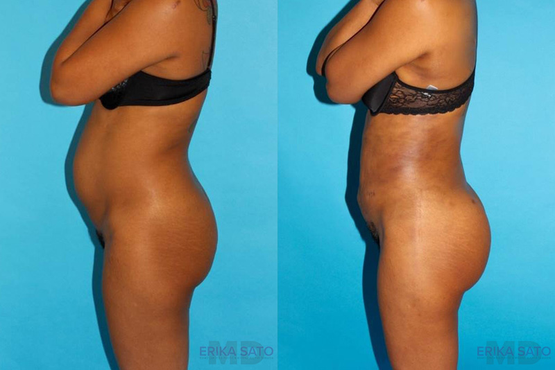 Brazilian Butt Lift case #4640