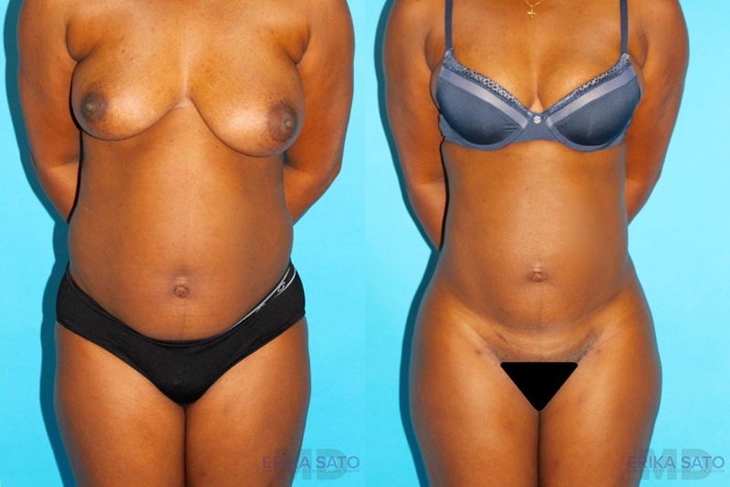 Brazilian Butt Lift case #4634