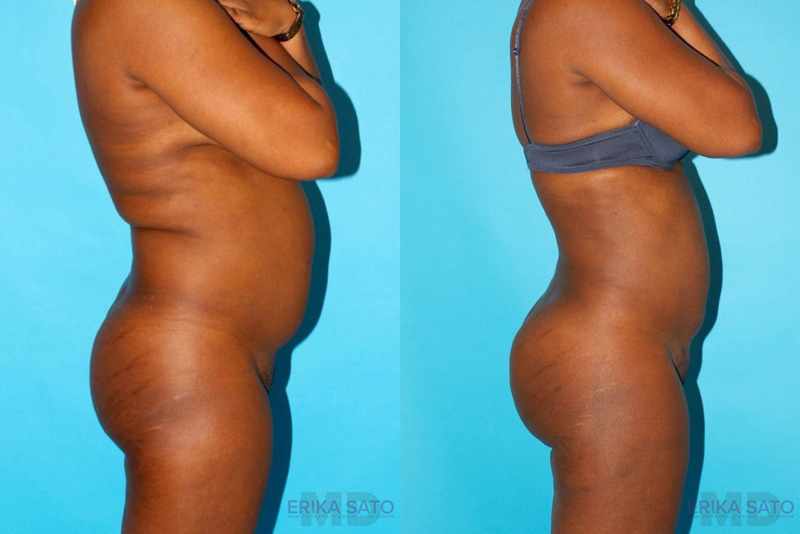 Brazilian Butt Lift case #4634