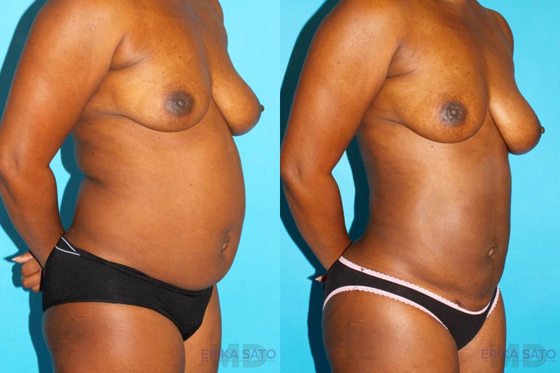 Brazilian Butt Lift case #4634