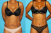 Tummy Tuck case #7232 slider thumbnail