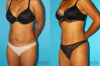 Tummy Tuck case #7232 slider thumbnail