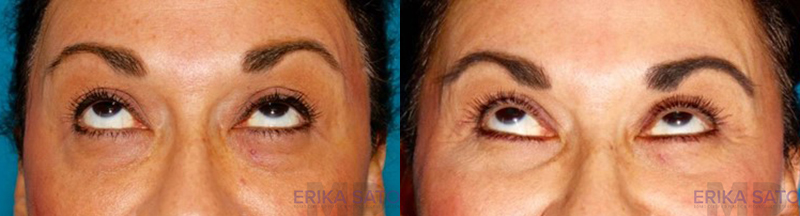 2384-90333-Blepharoplasty-before-and-after-photo-by-Dr.-Erika-A.-Sato-in-Houston-TX