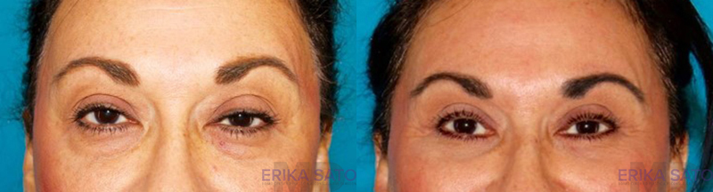2384-98919-Blepharoplasty-before-and-after-photo-by-Dr.-Erika-A.-Sato-in-Houston-TX
