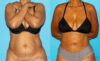 Liposuction case #5884 slider thumbnail