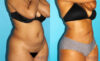 Liposuction case #5884 slider thumbnail
