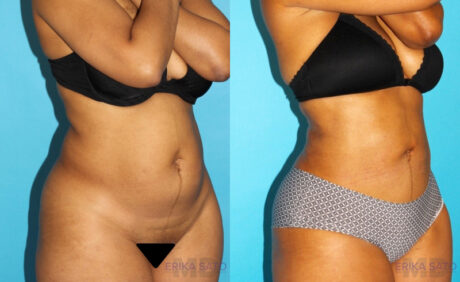 Liposuction case #5884