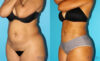 Liposuction case #5884 slider thumbnail