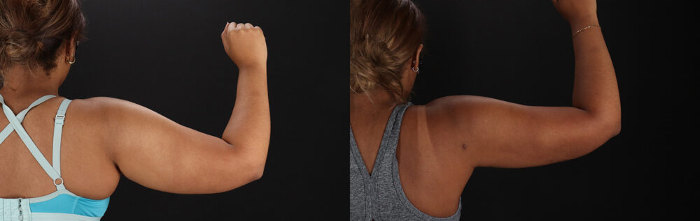 Brazilian Butt Lift case #5513