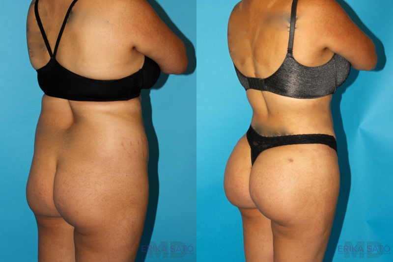 Brazilian Butt Lift case #4752