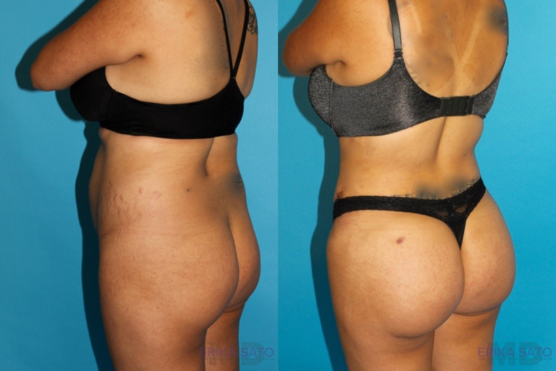 Brazilian Butt Lift case #4752