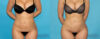 Liposuction case #4728 slider thumbnail
