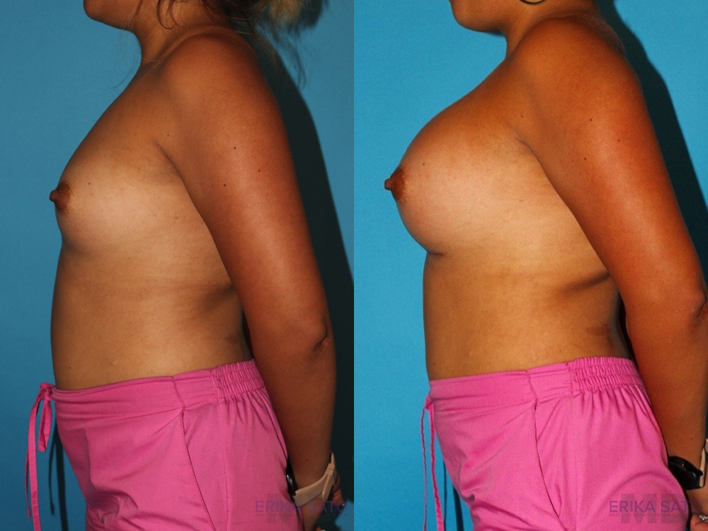 Breast Augmentation case #5659