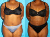 Liposuction case #5885 slider thumbnail