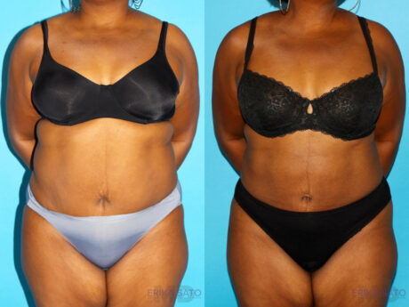 Liposuction case #5885